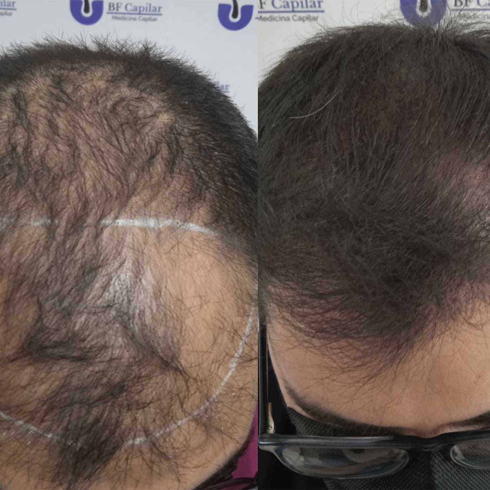 testimonio-de-tratamiendo-para-la-caida-del-cabello